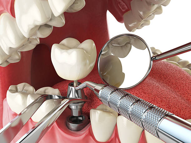 Best Emergency Denture Repair in Junction City, CA